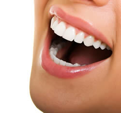 Teeth-whitening-1