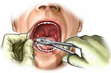 Extractions