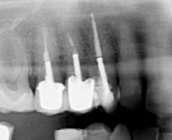 root-canal