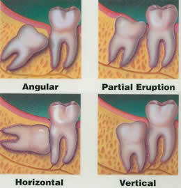 wisdom-teeth-2